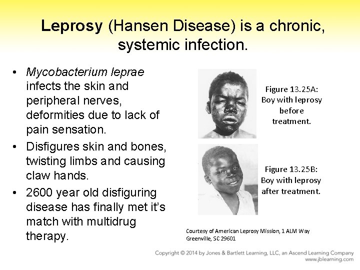 Leprosy (Hansen Disease) is a chronic, systemic infection. • Mycobacterium leprae infects the skin