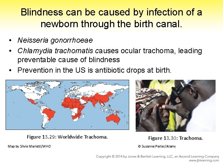 Blindness can be caused by infection of a newborn through the birth canal. •