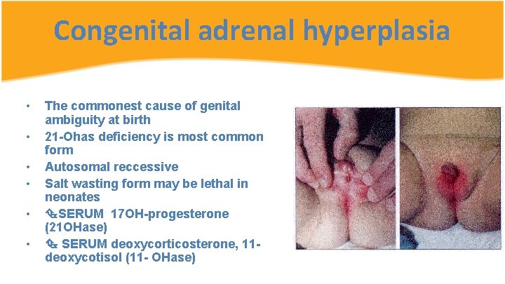 Congenital adrenal hyperplasia • • • The commonest cause of genital ambiguity at birth
