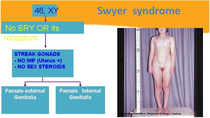 Swyer syndrome 46, XY No SRY OR its receptors STREAK GONADS - NO MIF