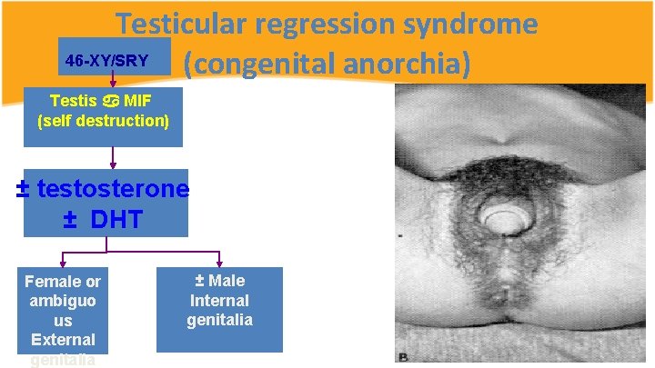 Testicular regression syndrome 46 -XY/SRY (congenital anorchia) Testis MIF (self destruction) ± testosterone ±