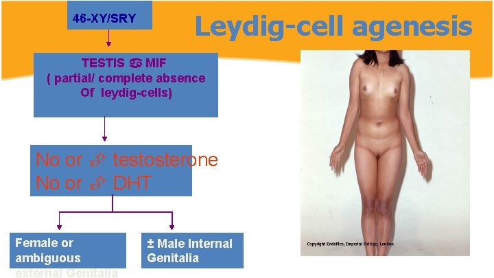 46 -XY/SRY Leydig-cell agenesis TESTIS MIF ( partial/ complete absence Of leydig-cells) No or