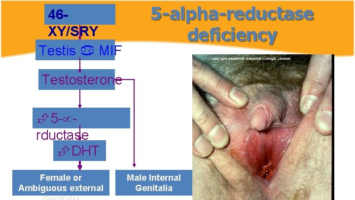 46 XY/SRY Testis MIF 5 -alpha-reductase deficiency Testosterone 5 - rductase DHT Female or