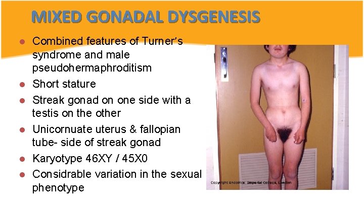 MIXED GONADAL DYSGENESIS l l l Combined features of Turner’s syndrome and male pseudohermaphroditism