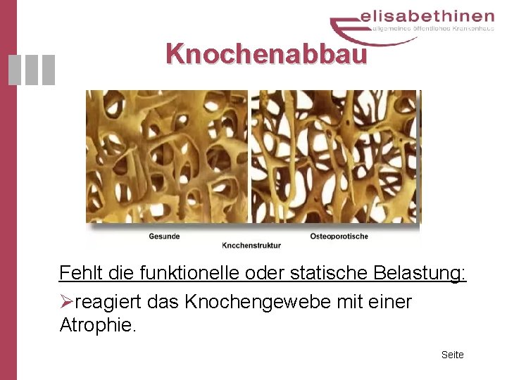 Knochenabbau Fehlt die funktionelle oder statische Belastung: Øreagiert das Knochengewebe mit einer Atrophie. Seite