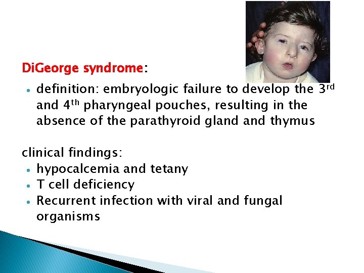 Di. George syndrome: definition: embryologic failure to develop the 3 rd and 4 th