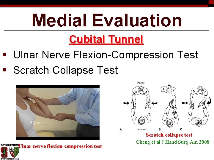 Medial Evaluation Cubital Tunnel § Ulnar Nerve Flexion-Compression Test § Scratch Collapse Test Ulnar