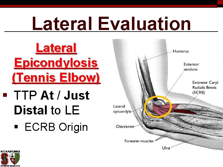 Lateral Evaluation Lateral Epicondylosis (Tennis Elbow) § TTP At / Just Distal to LE