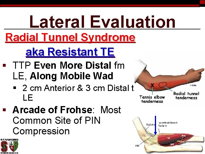 Lateral Evaluation Radial Tunnel Syndrome aka Resistant TE § TTP Even More Distal fm