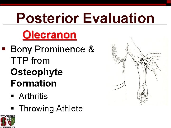 Posterior Evaluation Olecranon § Bony Prominence & TTP from Osteophyte Formation § Arthritis §