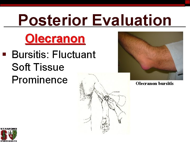 Posterior Evaluation Olecranon § Bursitis: Fluctuant Soft Tissue Prominence Olecranon bursitis 