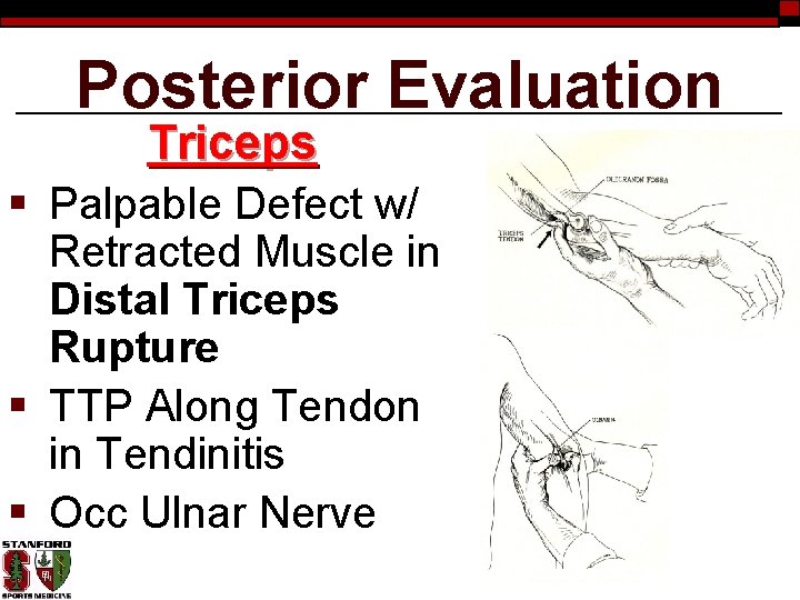 Posterior Evaluation Triceps § Palpable Defect w/ Retracted Muscle in Distal Triceps Rupture §