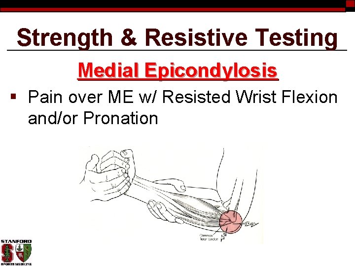 Strength & Resistive Testing Medial Epicondylosis § Pain over ME w/ Resisted Wrist Flexion