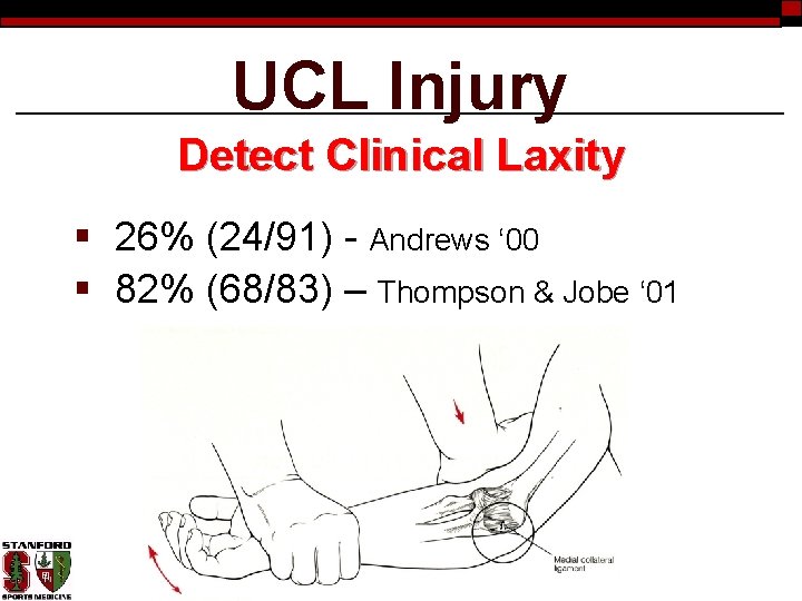 UCL Injury Detect Clinical Laxity § 26% (24/91) - Andrews ‘ 00 § 82%