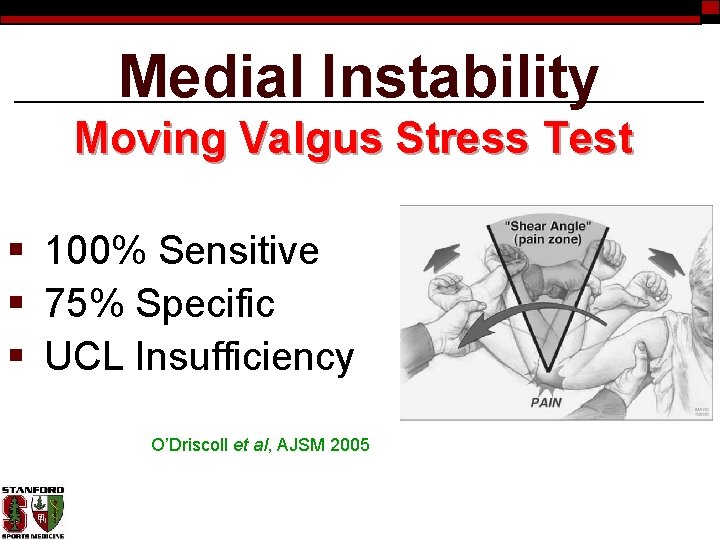 Medial Instability Moving Valgus Stress Test § 100% Sensitive § 75% Specific § UCL