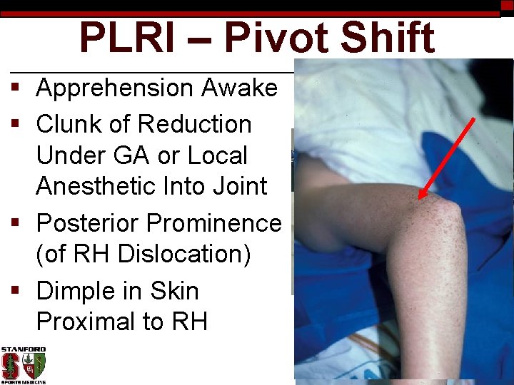 PLRI – Pivot Shift § Apprehension Awake § Clunk of Reduction Under GA or