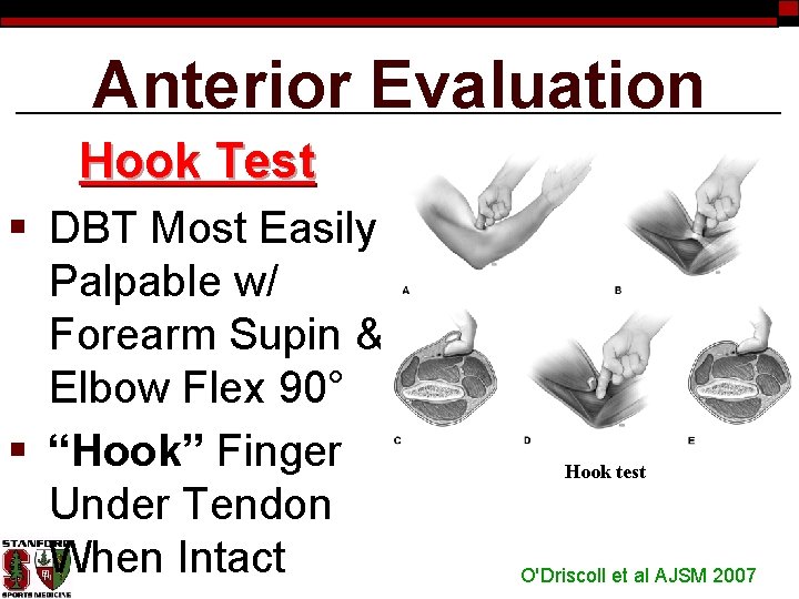 Anterior Evaluation Hook Test § DBT Most Easily Palpable w/ Forearm Supin & Elbow