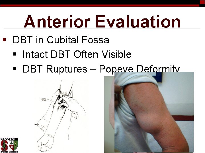 Anterior Evaluation § DBT in Cubital Fossa § Intact DBT Often Visible § DBT