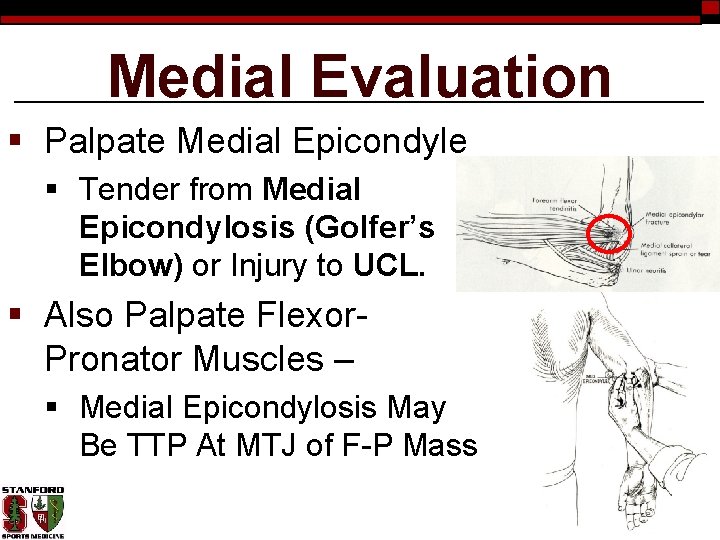 Medial Evaluation § Palpate Medial Epicondyle § Tender from Medial Epicondylosis (Golfer’s Elbow) or