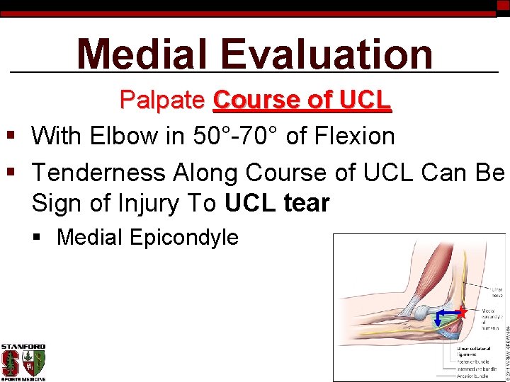 Medial Evaluation Palpate Course of UCL § With Elbow in 50°-70° of Flexion §