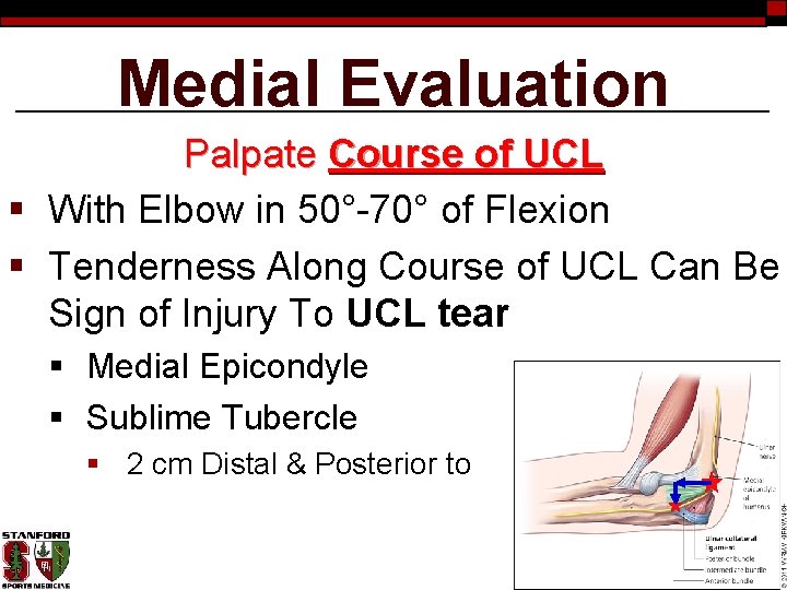 Medial Evaluation Palpate Course of UCL § With Elbow in 50°-70° of Flexion §