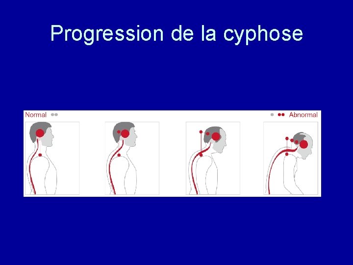 Progression de la cyphose 