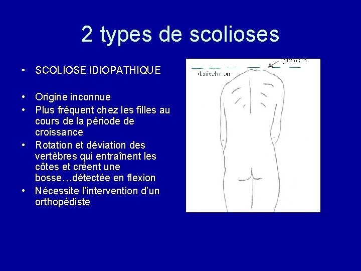 2 types de scolioses • SCOLIOSE IDIOPATHIQUE • Origine inconnue • Plus fréquent chez