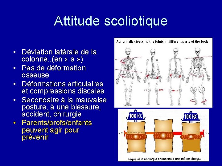 Attitude scoliotique • Déviation latérale de la colonne. . (en « s » )