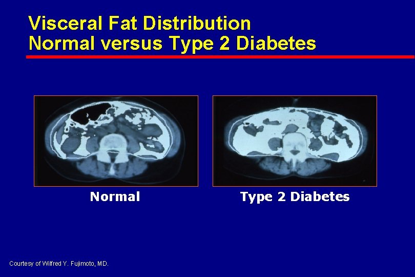 Visceral Fat Distribution Normal versus Type 2 Diabetes Normal Courtesy of Wilfred Y. Fujimoto,