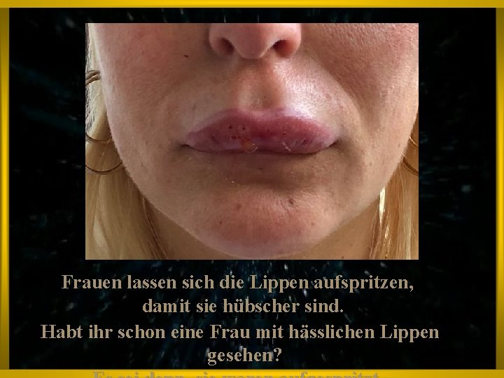 Frauen lassen sich die Lippen aufspritzen, damit sie. Scheiße hübschervon sind. Die Habt ihr