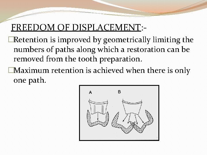 FREEDOM OF DISPLACEMENT: �Retention is improved by geometrically limiting the numbers of paths along