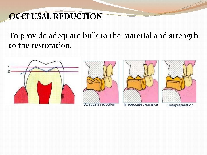OCCLUSAL REDUCTION To provide adequate bulk to the material and strength to the restoration.