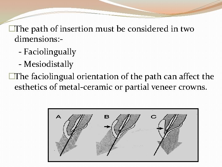 �The path of insertion must be considered in two dimensions: - Faciolingually - Mesiodistally