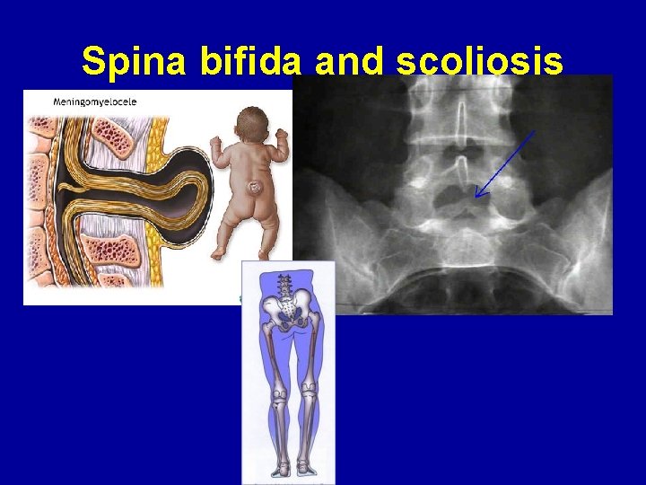 Spina bifida and scoliosis 