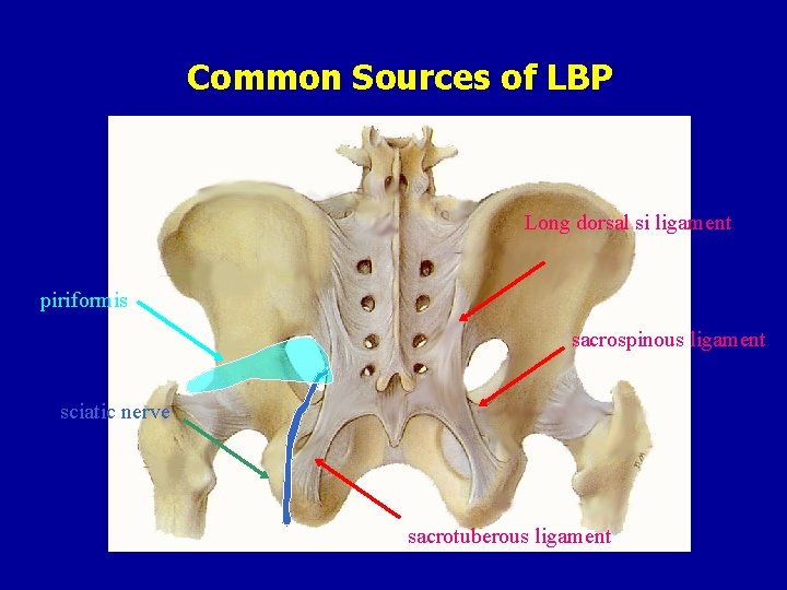 Common Sources of LBP Long dorsal si ligament piriformis sacrospinous ligament sciatic nerve sacrotuberous