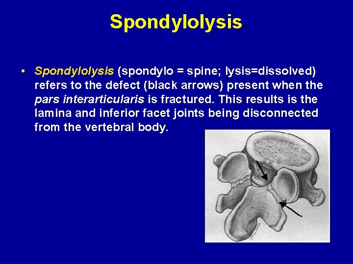 Spondylolysis • Spondylolysis (spondylo = spine; lysis=dissolved) refers to the defect (black arrows) present