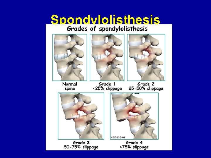 Spondylolisthesis 