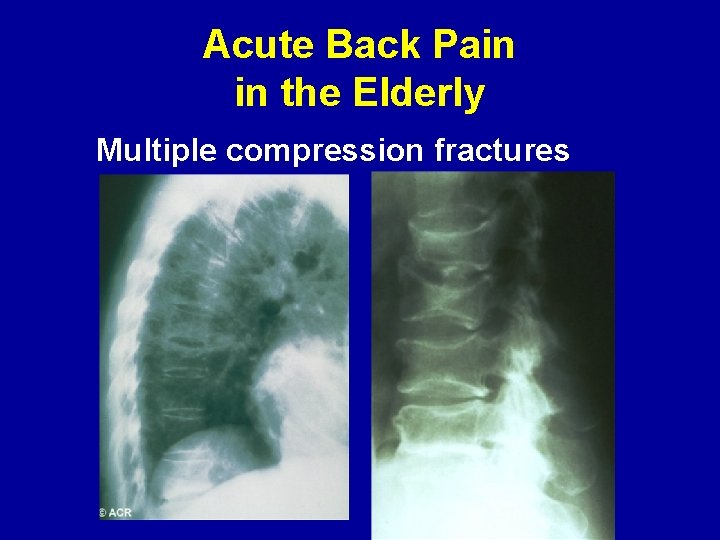 Acute Back Pain in the Elderly Multiple compression fractures 