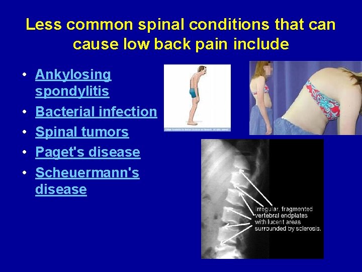 Less common spinal conditions that can cause low back pain include • Ankylosing spondylitis