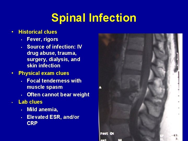 Spinal Infection • Historical clues • Fever, rigors • Source of infection: IV drug