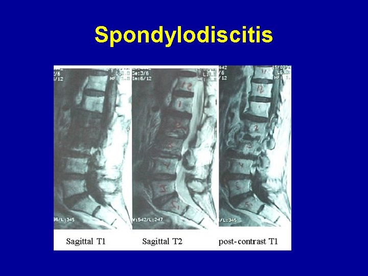 Spondylodiscitis 