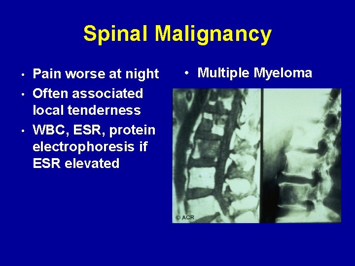 Spinal Malignancy • • • Pain worse at night Often associated local tenderness WBC,