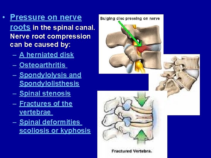  • Pressure on nerve roots in the spinal canal. Nerve root compression can