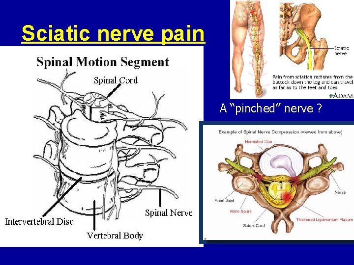 Sciatic nerve pain A “pinched” nerve ? 