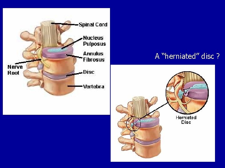 A “herniated” disc ? 
