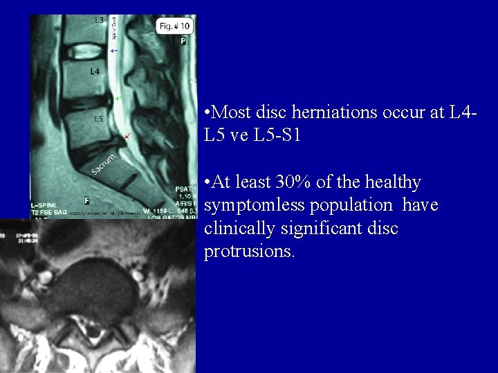  • Most disc herniations occur at L 4 L 5 ve L 5