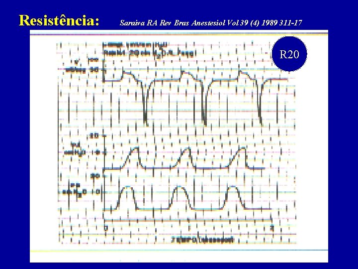 Resistência: Saraiva RA Rev Bras Anestesiol Vol 39 (4) 1989 311 -17 R 20