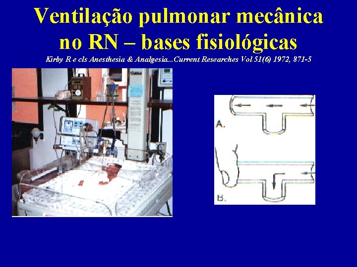 Ventilação pulmonar mecânica no RN – bases fisiológicas Kirby R e cls Anesthesia &