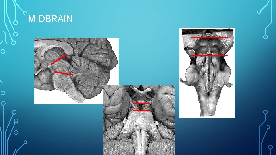 MIDBRAIN 