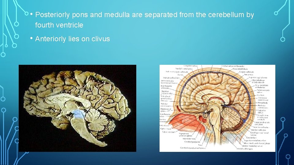  • Posteriorly pons and medulla are separated from the cerebellum by fourth ventricle
